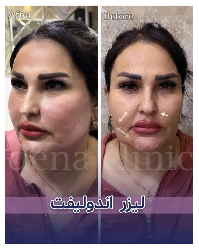 نمونه کار نمونه کاشت مو کلینیک زیبایی باران شیراز