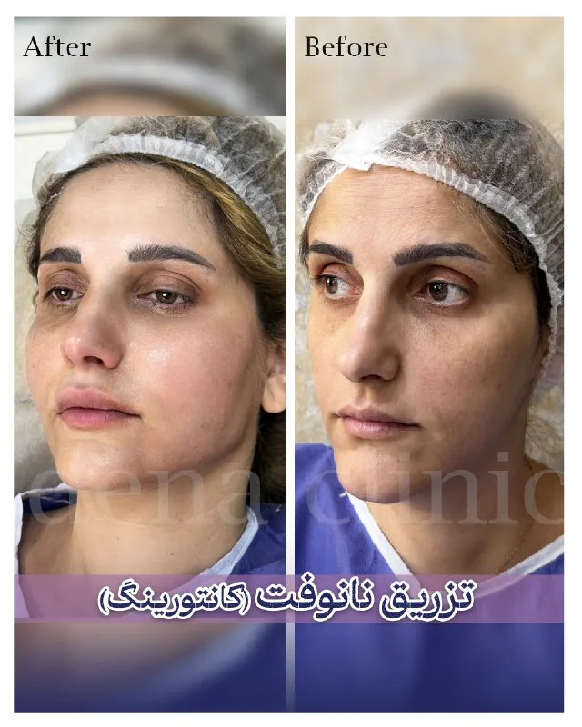 نمونه کانتورینگ نمونه کاشت مو کلینیک زیبایی باران شیراز