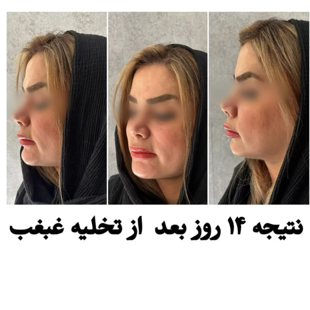 نمونه تخلیه غبغب لینیک زیبایی دکتر پوریا رمضانی شیراز