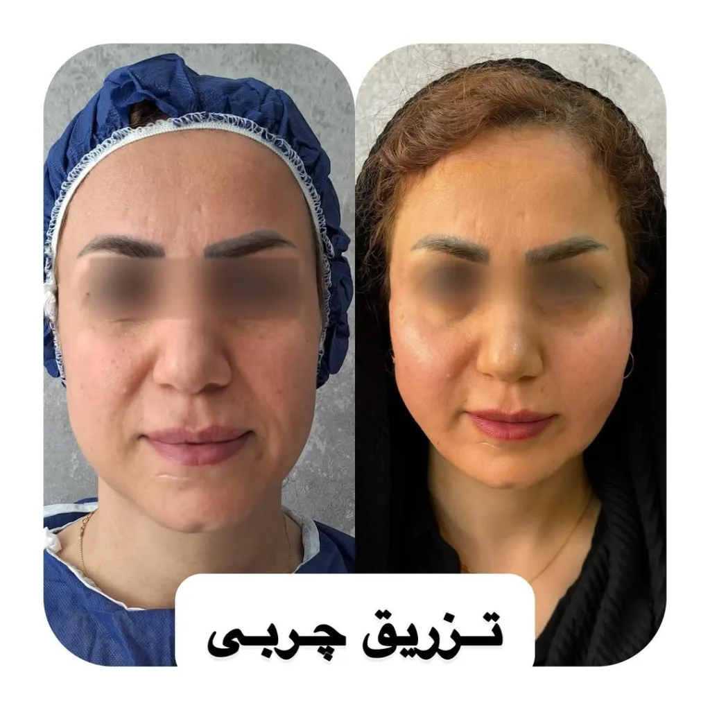 نمونه تزریق چربی لینیک زیبایی دکتر پوریا رمضانی شیراز