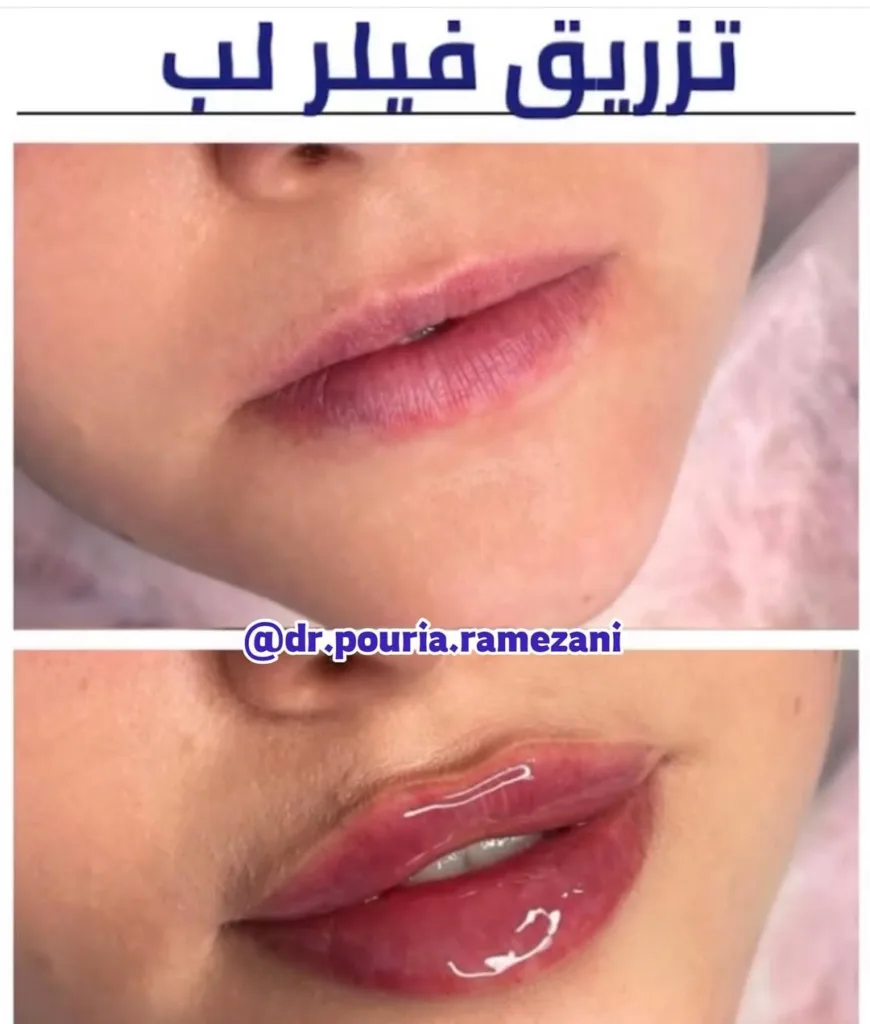 نمونه فیلر لب کلینیک زیبایی دکتر پوریا رمضانی شیراز