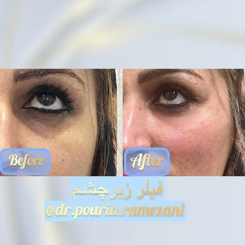 نمونه فیلر زیر چشم کلینیک زیبایی دکتر پوریا رمضانی شیراز