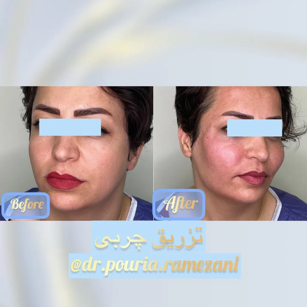 نمونه تزریق چربی کلینیک زیبایی دکتر پوریا رمضانی شیراز