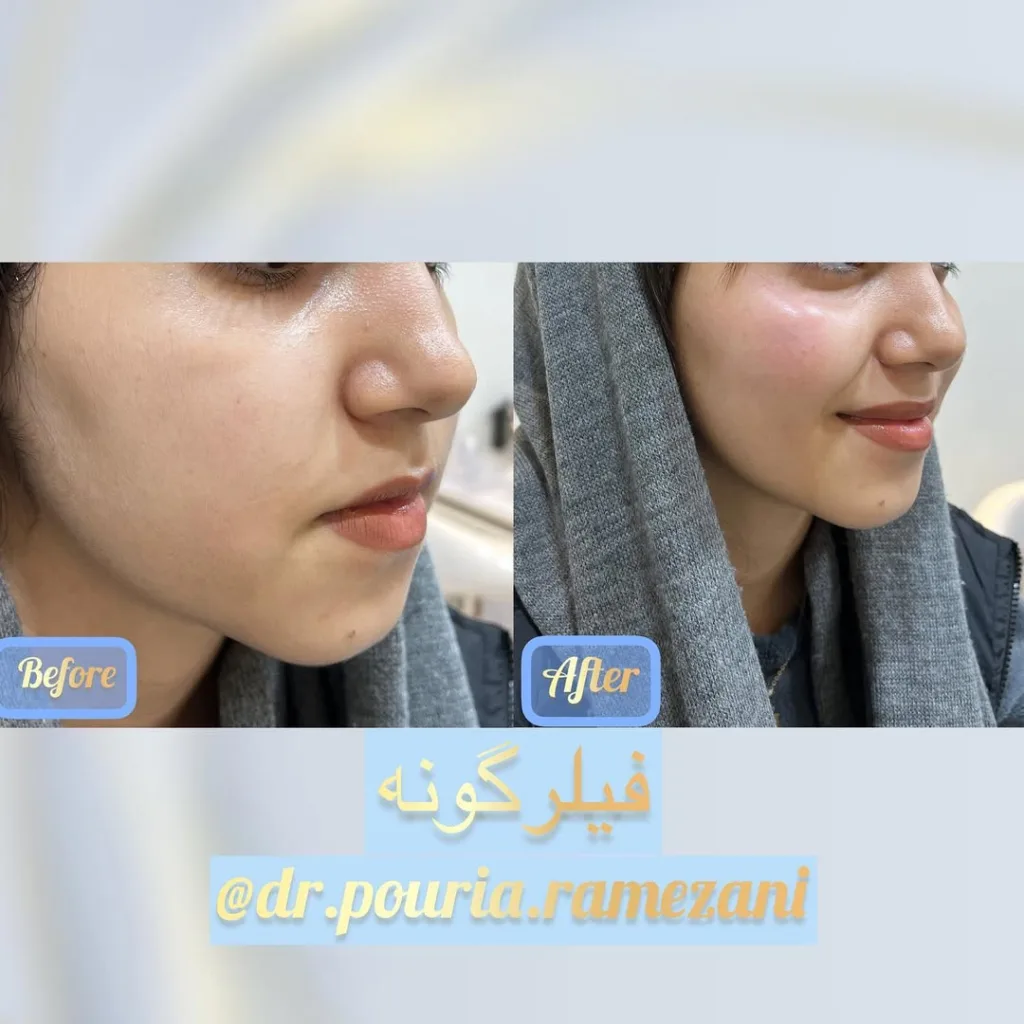 نمونه فیلر گونه کلینیک زیبایی دکتر پوریا رمضانی شیراز
