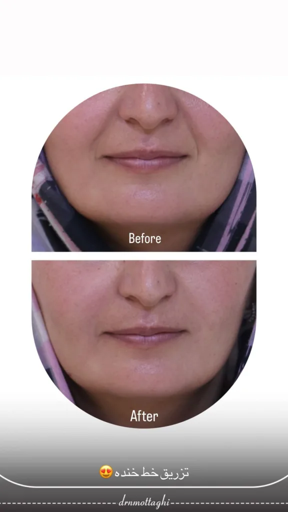نمونه تزریق خط خنده کلینیک زیبایی دکتر متقی شیراز