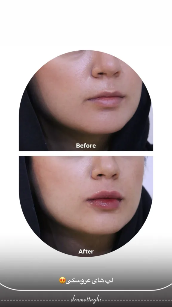 نمونه فیلر لب کلینیک زیبایی دکتر متقی شیراز