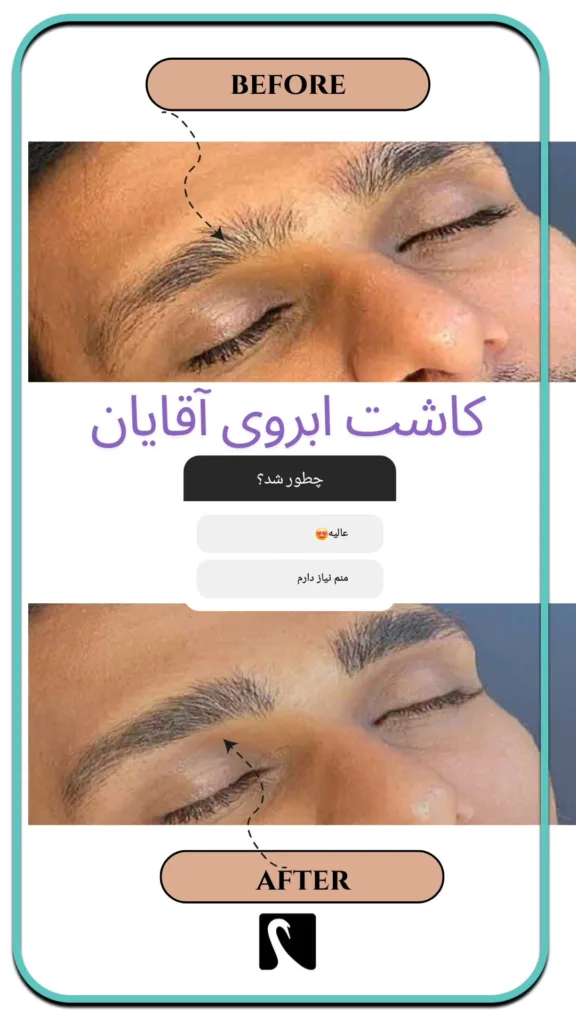 نمونه کاشت ابرو کلینیک زیبایی آرمانی شیراز