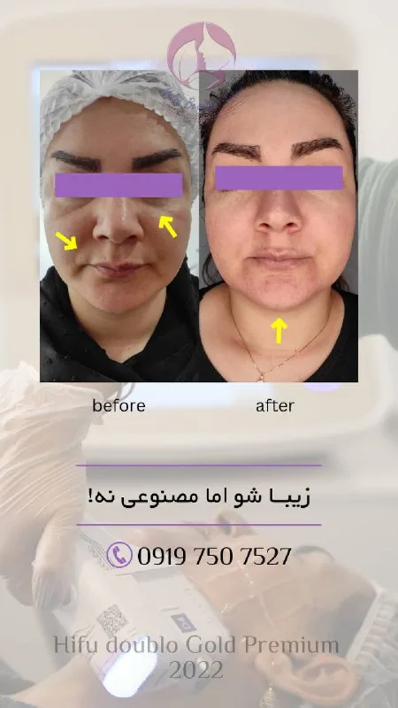 نمونه کار مرکز لیزر نلسا بیوتی سمنان