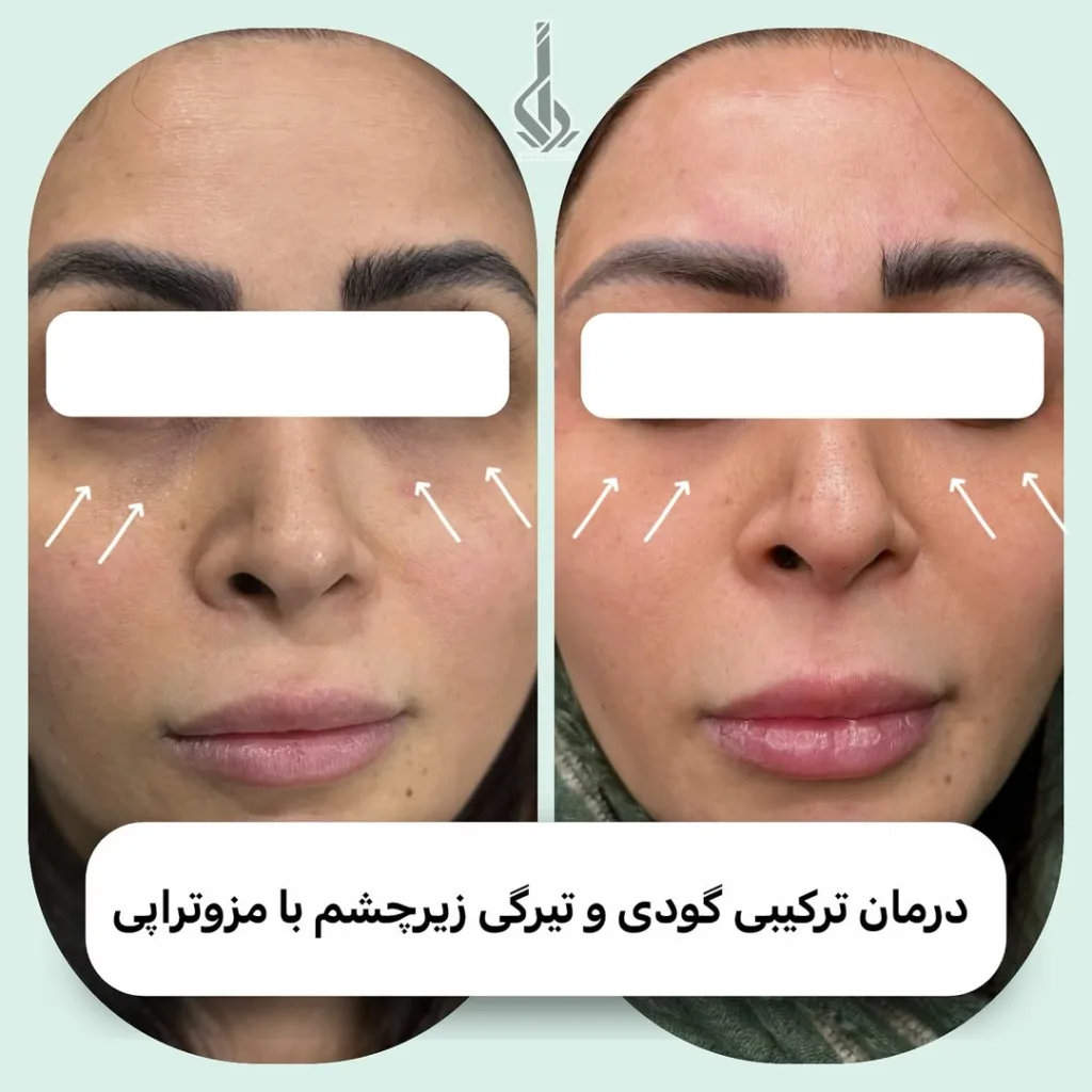 نمونه درمان ترکیبی گودی تیرگی چشم مرکز تخصصی لیزر ایرانیان اهواز