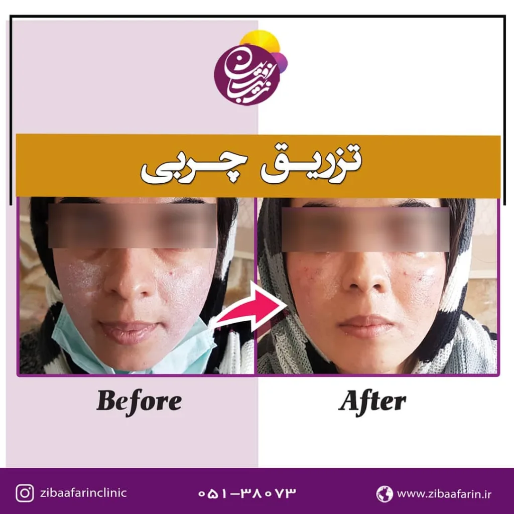 نمونه تزریق بوتاکس کلینیک تخصصی پوست و مو زیباآفرین مشهد