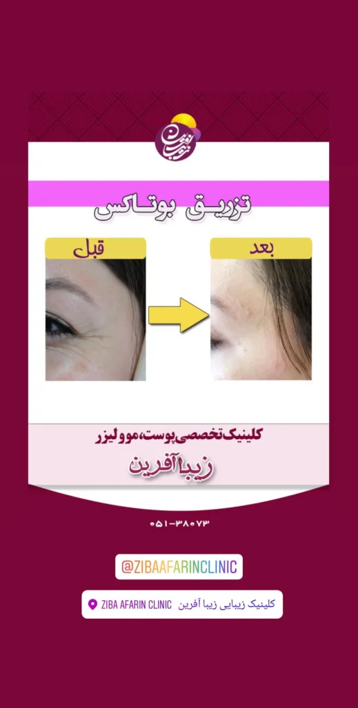 نمونه تزریق بوتاکس کلینیک تخصصی پوست و مو زیباآفرین مشهد