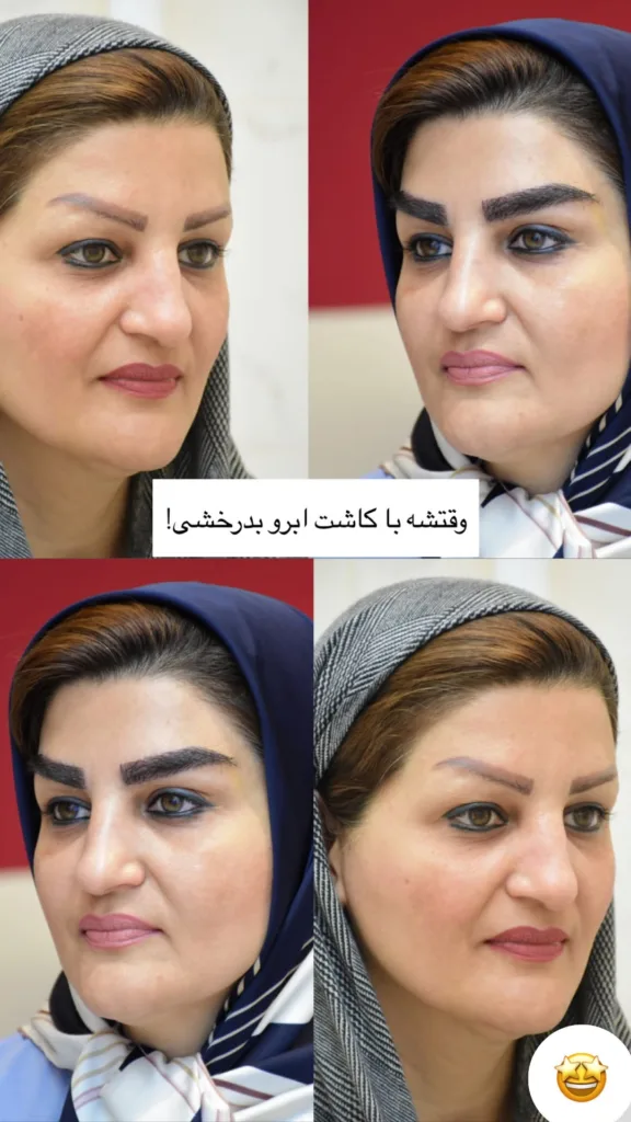 نمونه کاشت ابرو کلینیک تخصصی پوست و مو باران توس مشهد
