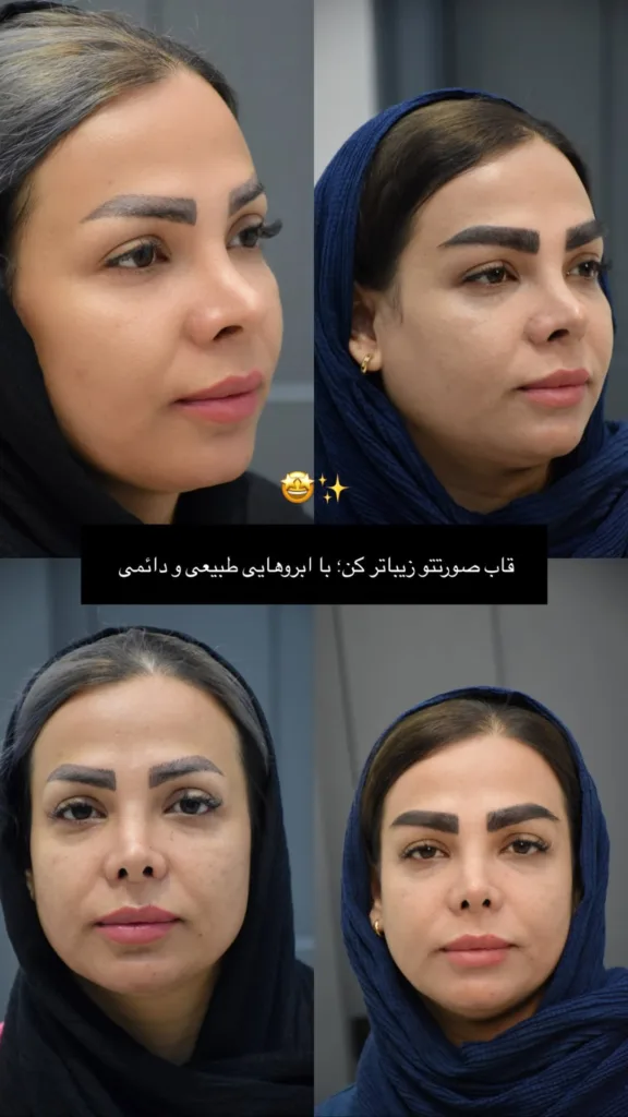نمونه کاشت ابرو کلینیک تخصصی پوست و مو باران توس مشهد