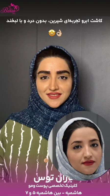 نمونه کاشت ابرو کلینیک تخصصی پوست و مو باران توس مشهد
