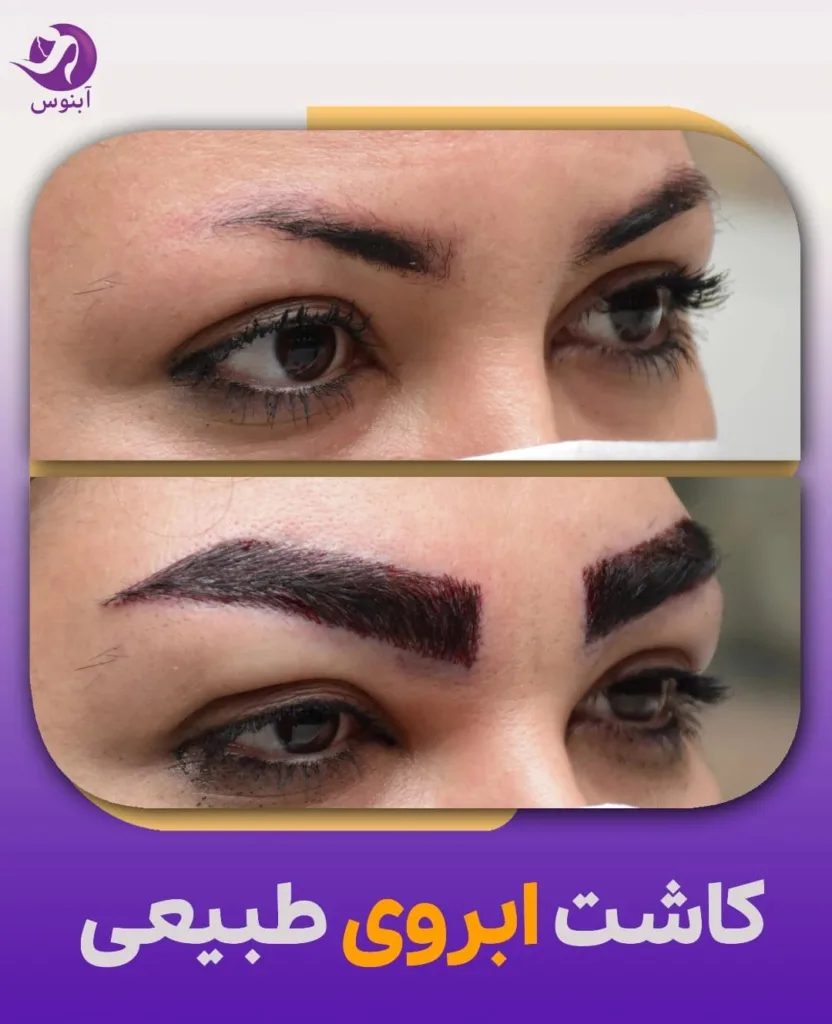 نمونه کاشت ابرو کلینیک زیبایی آبنوس مشهد