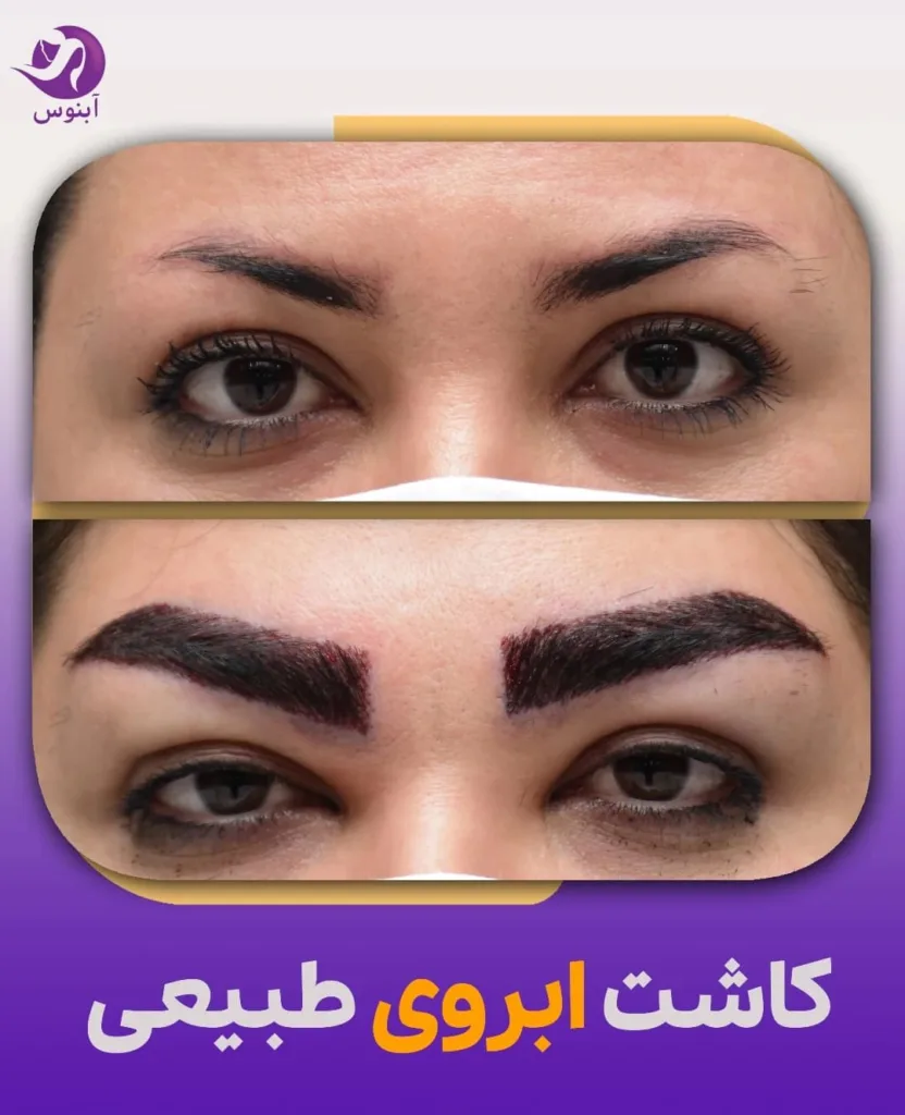 نمونه کاشت ابرو کلینیک زیبایی آبنوس مشهد