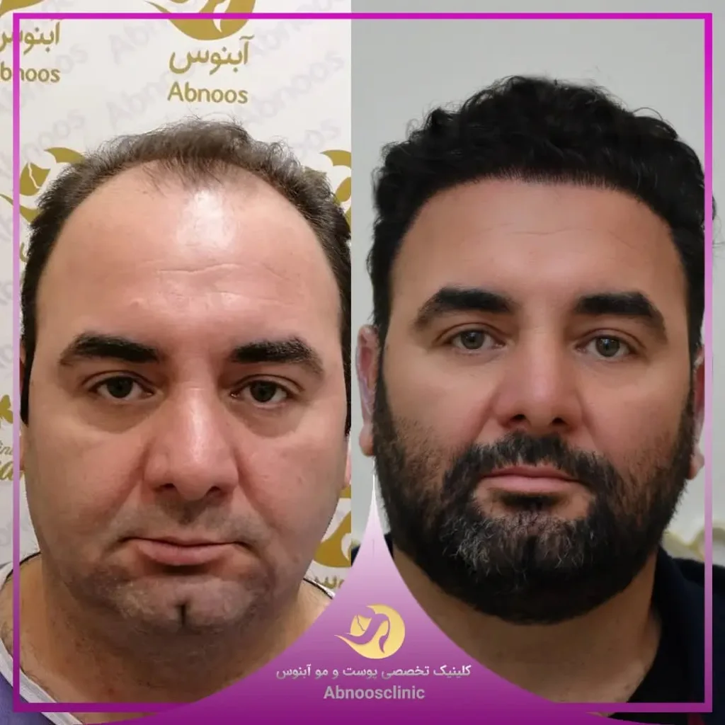نمونه کاشت مو کلینیک زیبایی آبنوس مشهد