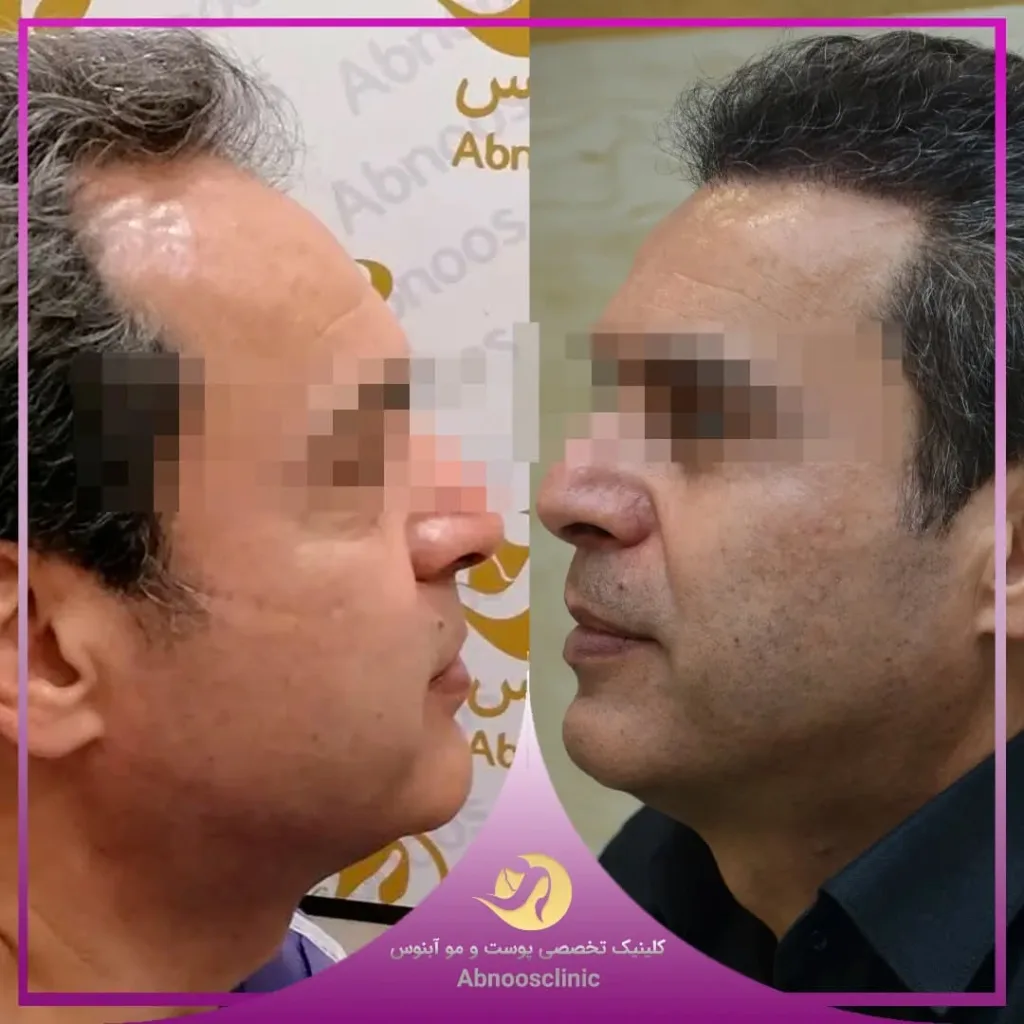 نمونه کاشت مو کلینیک زیبایی آبنوس مشهد