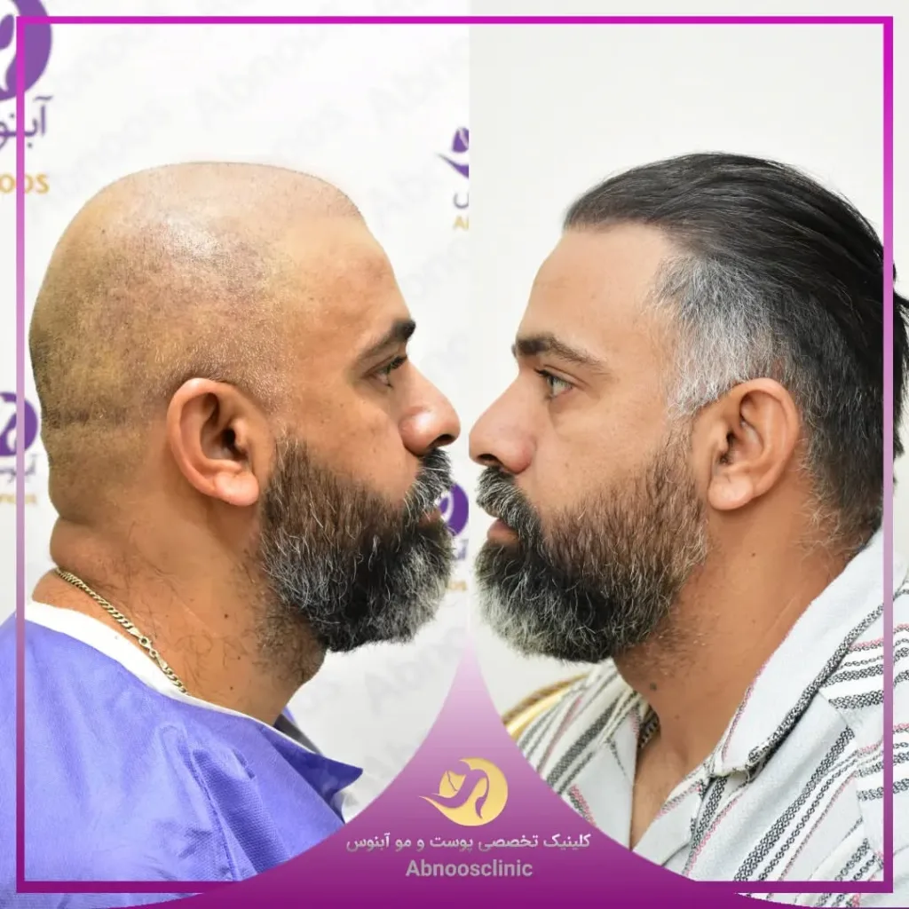 نمونه کاشت مو کلینیک زیبایی آبنوس مشهد