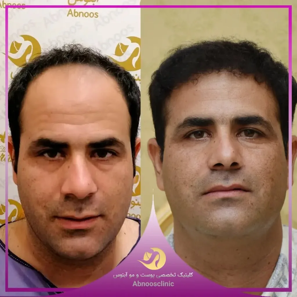 نمونه کاشت مو کلینیک زیبایی آبنوس مشهد