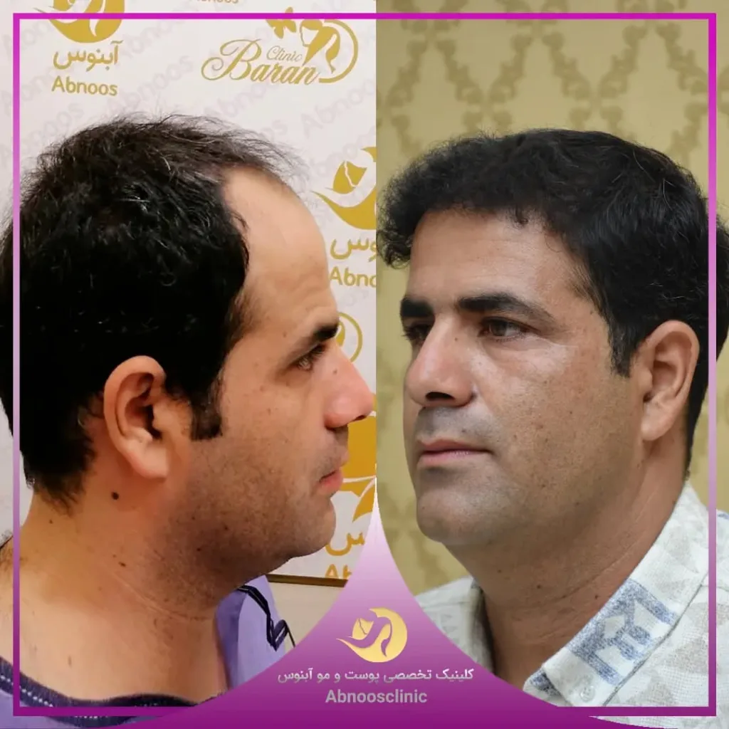 نمونه کاشت مو کلینیک زیبایی آبنوس مشهد