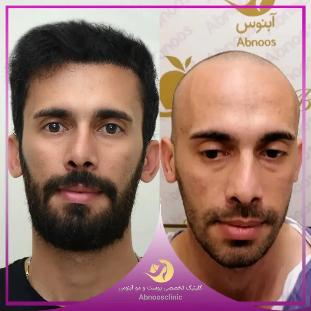 نمونه کاشت مو کلینیک زیبایی آبنوس مشهد