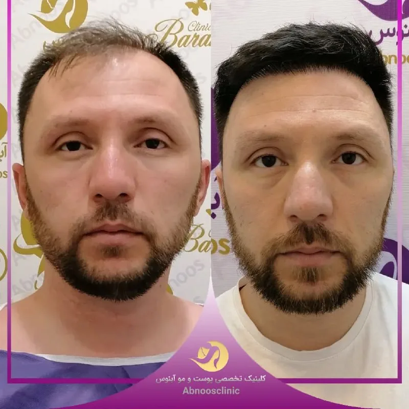 نمونه کاشت مو کلینیک زیبایی آبنوس مشهد