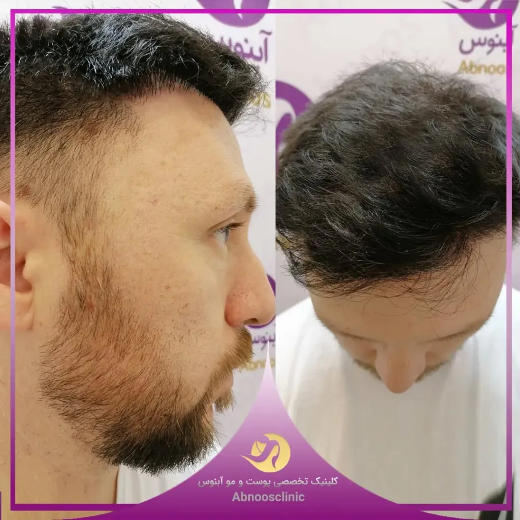 نمونه کاشت مو کلینیک زیبایی آبنوس مشهد