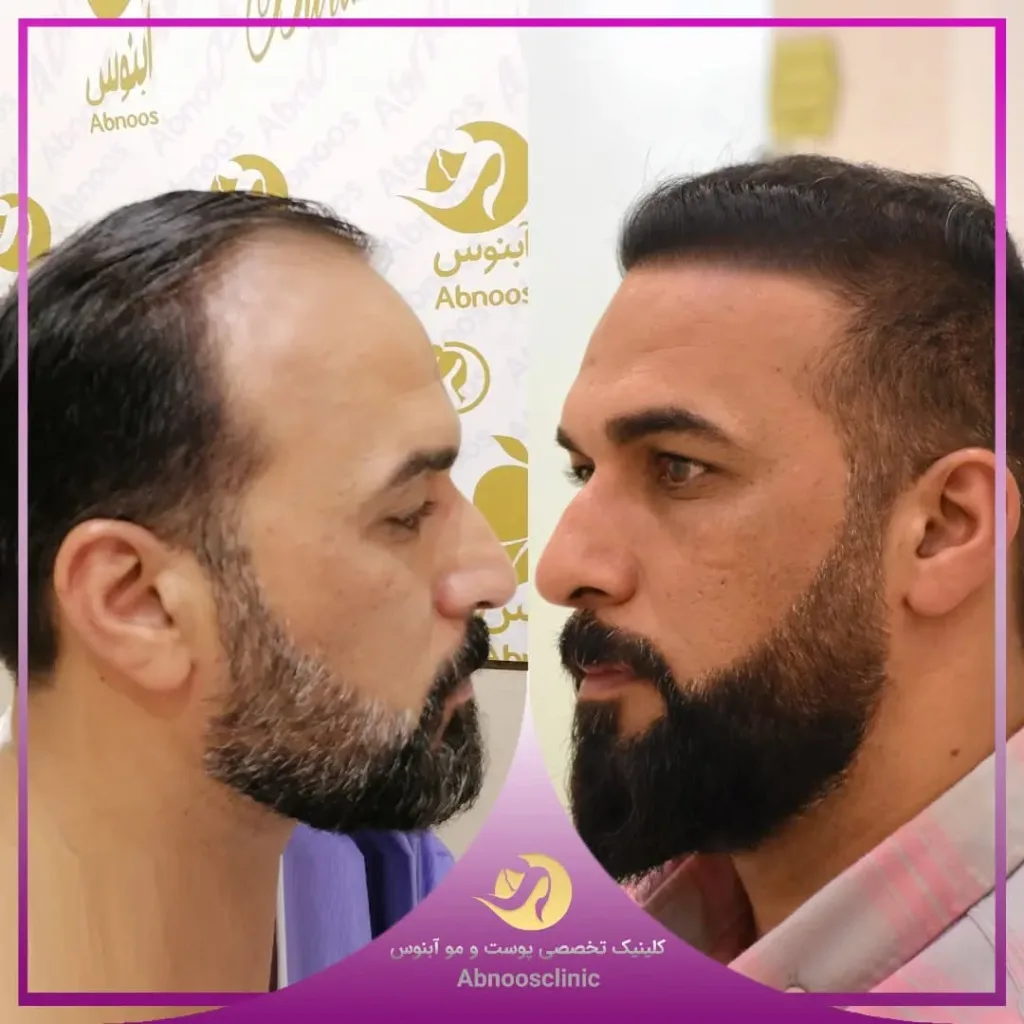نمونه کاشت مو کلینیک زیبایی آبنوس مشهد