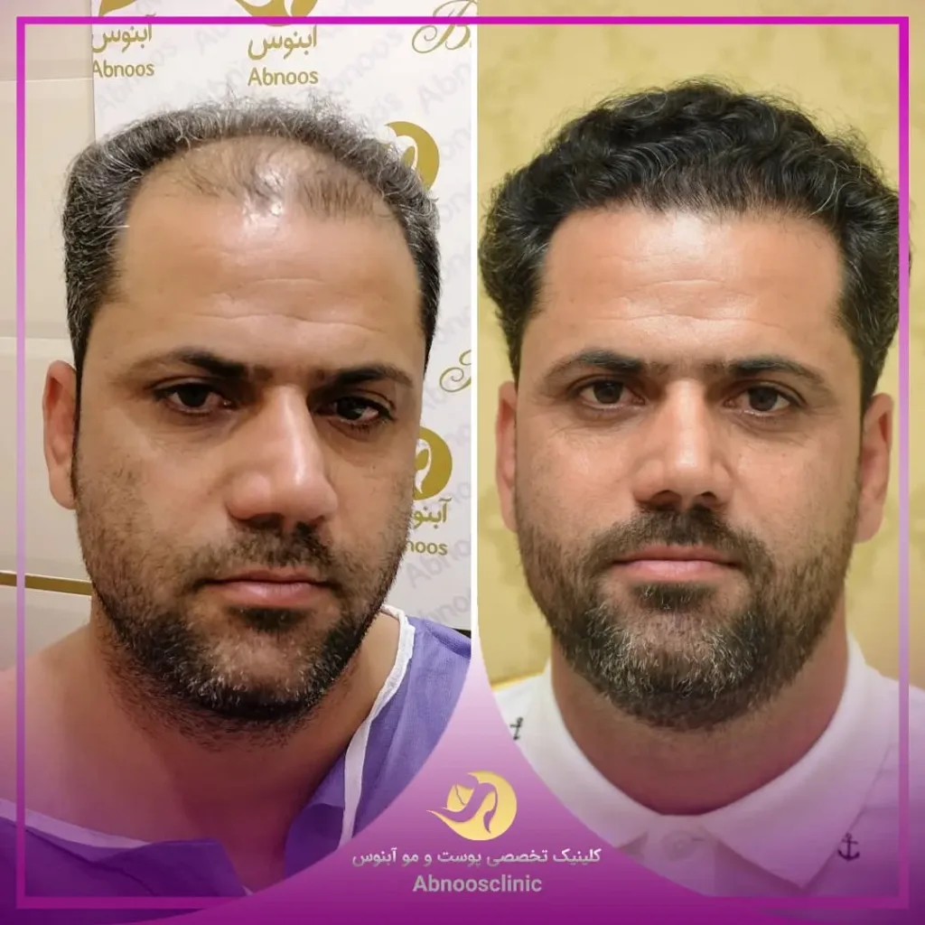 نمونه کاشت مو کلینیک زیبایی آبنوس مشهد