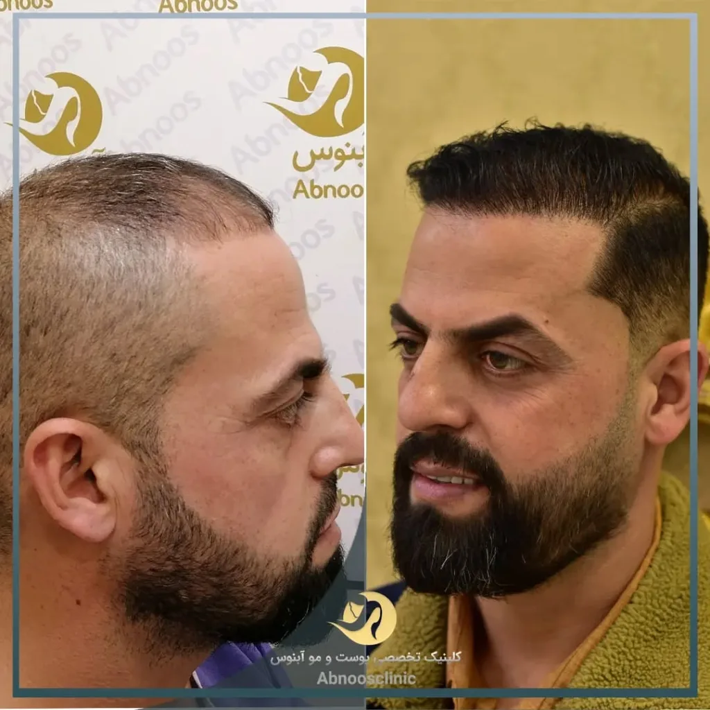 نمونه کاشت مو کلینیک زیبایی آبنوس مشهد
