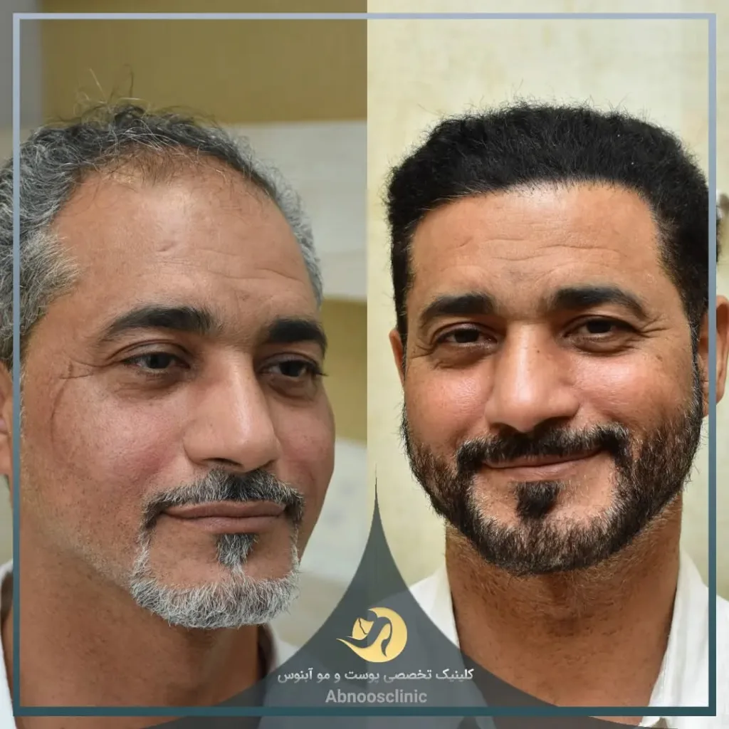 نمونه کاشت مو کلینیک زیبایی آبنوس مشهد