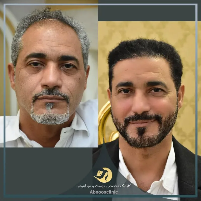 نمونه کاشت مو کلینیک زیبایی آبنوس مشهد