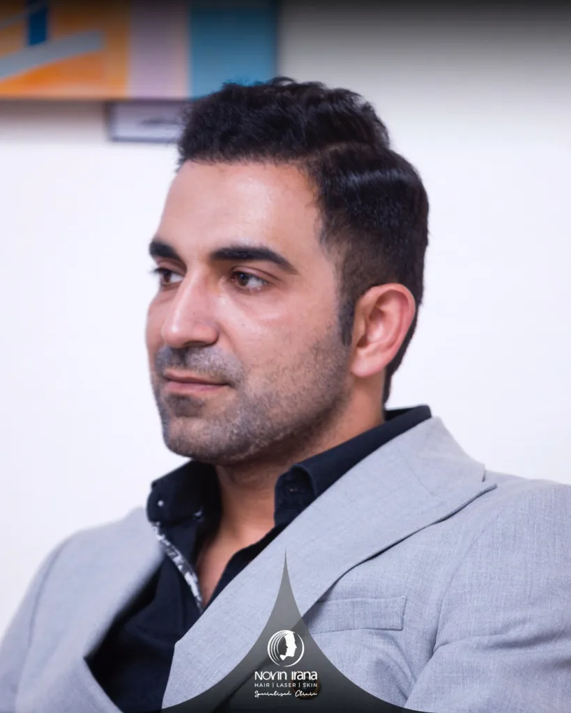 نمونه کاشت مو کلینیک زیبایی نوین ایرانا مشهد