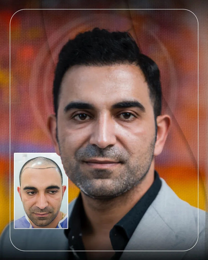 نمونه کاشت مو کلینیک زیبایی نوین ایرانا مشهد