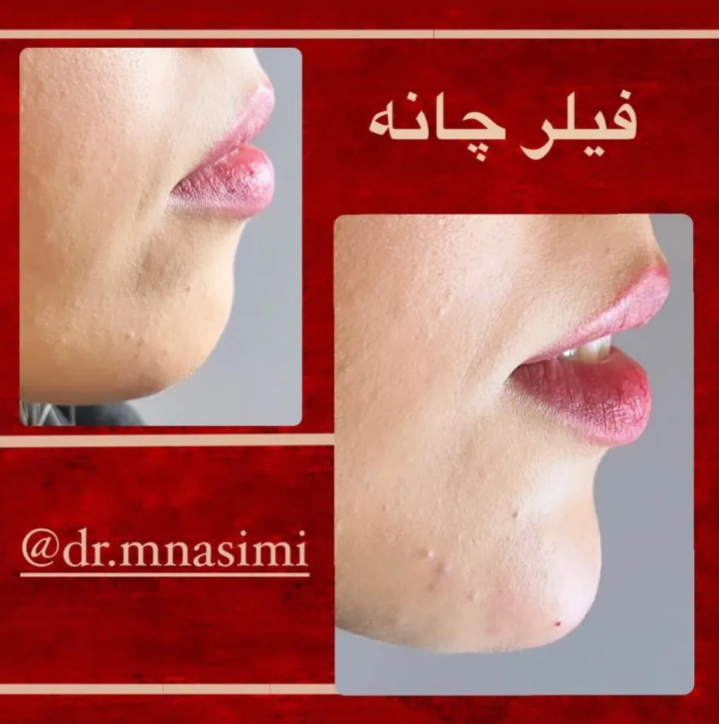 نمونه فیلر چانه مطب دکتر مجتبی نسیمی بیرجند