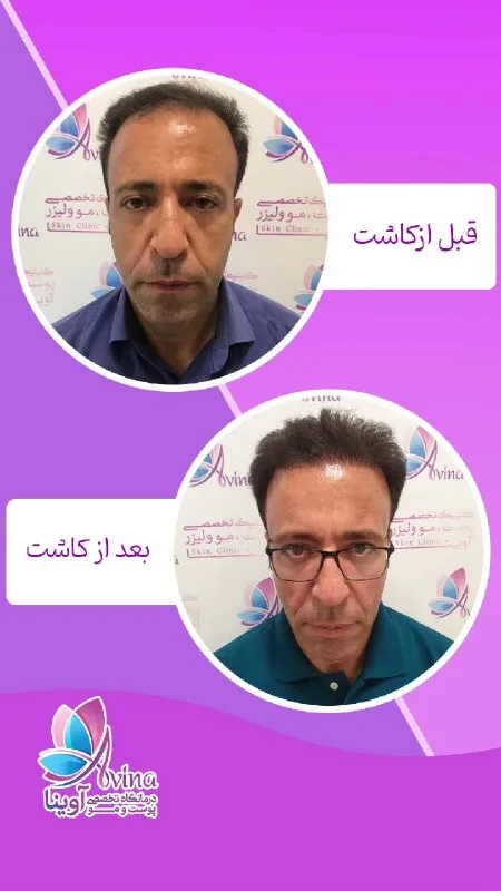 نمونه کاشت مو لینیک پوست و مو آوینا کرج