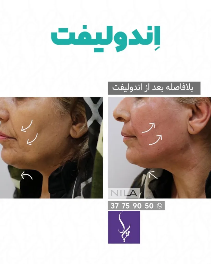 نمونه کار کلینیک زیبایی نیلا اصفهان