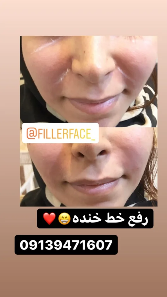 نمونه رفع خط خنده کلینیک تخصصی پوست و مو دکتر سعیده برجی سیرجان