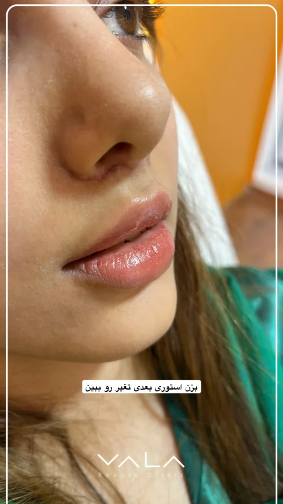 نمونه کار کلینیک زیبایی والا کرمان فیلر لب