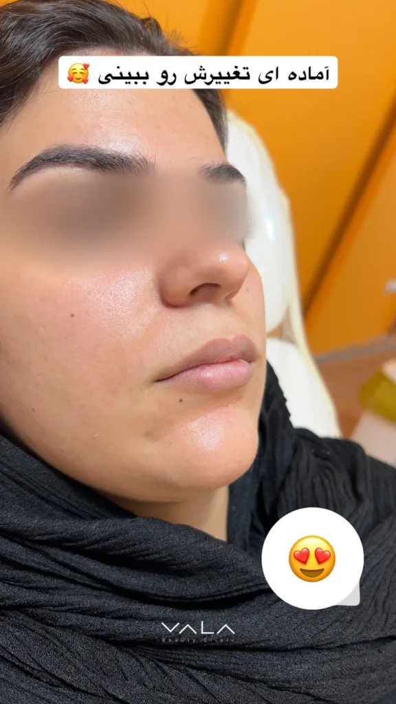 نمونه کار کلینیک زیبایی والا کرمان فیلر لب