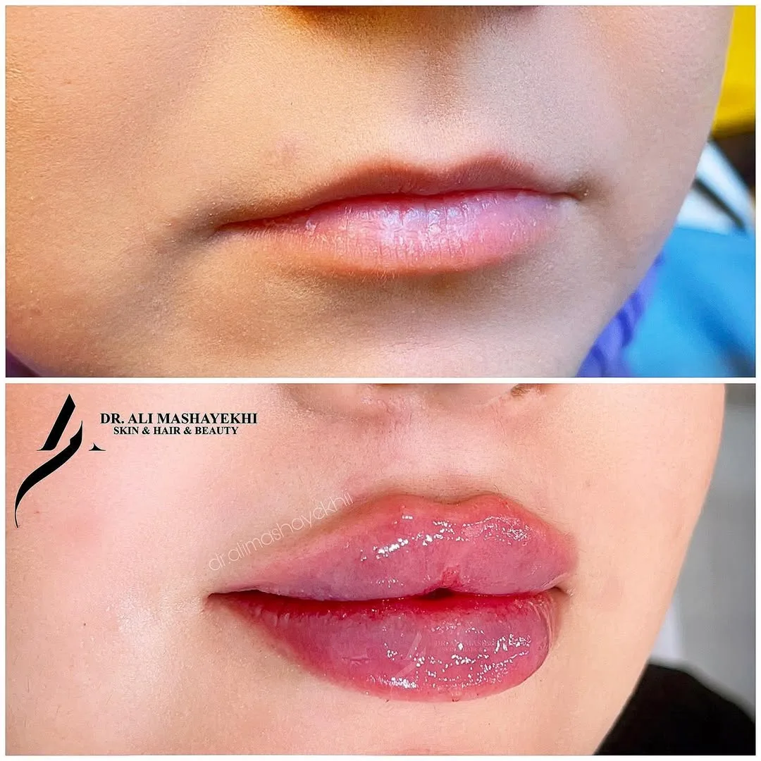 نمونه کار کلینیک زیبایی دکتر علی مشایخ کرمان فیلر لب