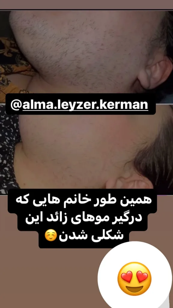 نمونه کار لیزر کلینیک زیبایی آلما کرمان