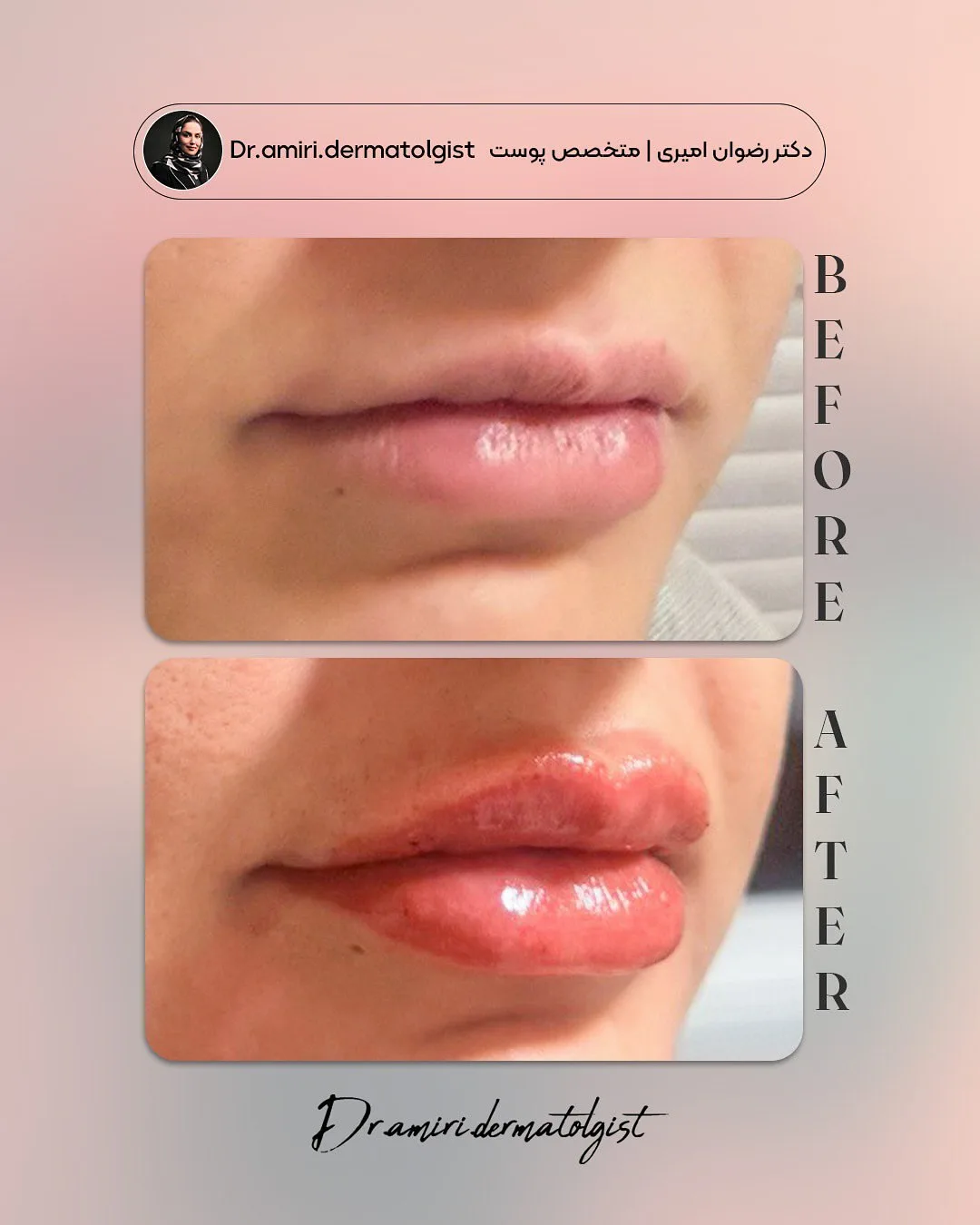 نمونه فیلر کلینیک زیبایی مانا کرمان