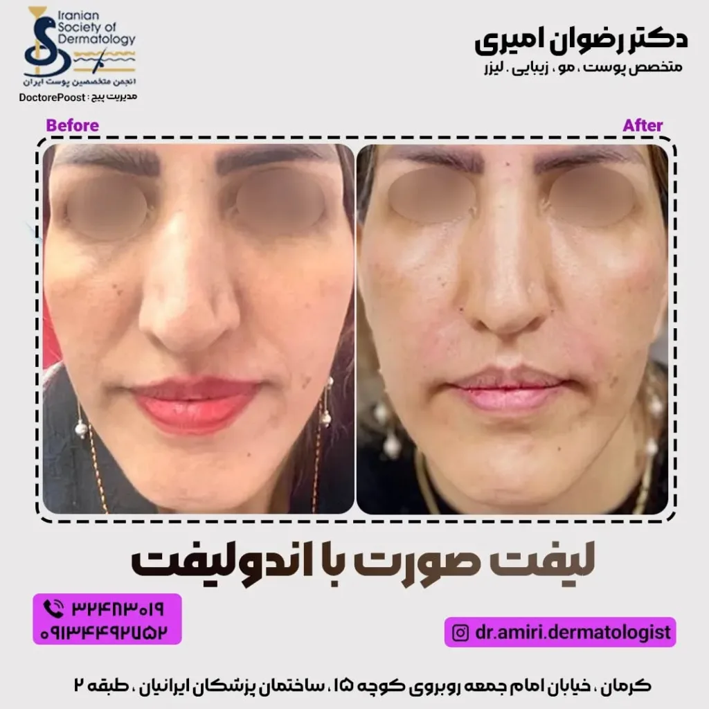 نمونه لیفت صورت کلینیک زیبایی مانا کرمان