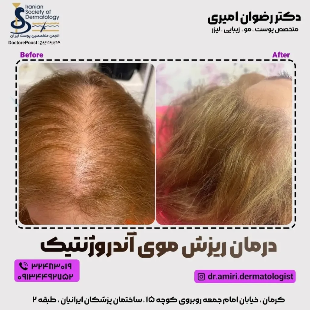 نمونه درمان ریزش مو کلینیک زیبایی مانا کرمان