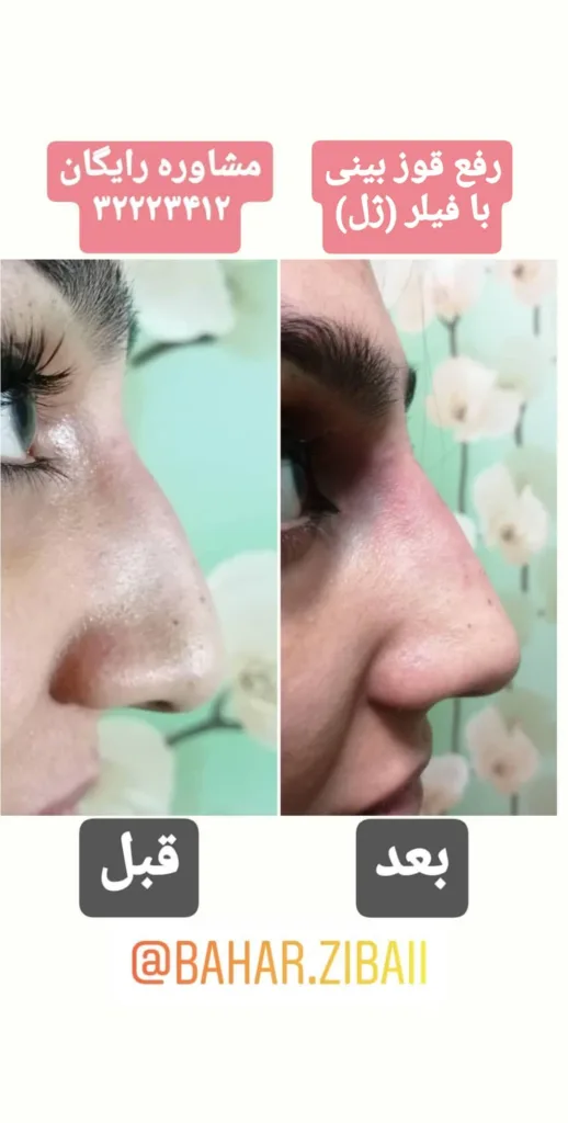 نمونه رفع قوز بینی کلینیک زیبایی آیدا شهیدی کرمان