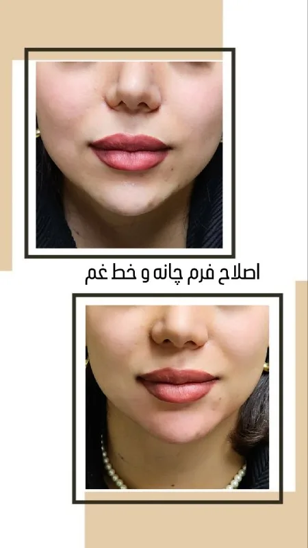 نمونه اصلاح فرم چانه کلینیک زیبایی دکتر محمدرضا رضایی کرمان