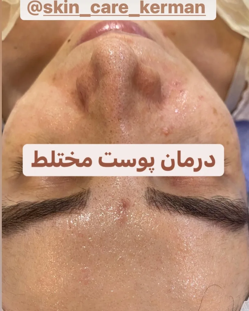 نمونه درمان پوست مختلط مطب پوست مو ولیزر دکترعلیرضابهرامی کرمان