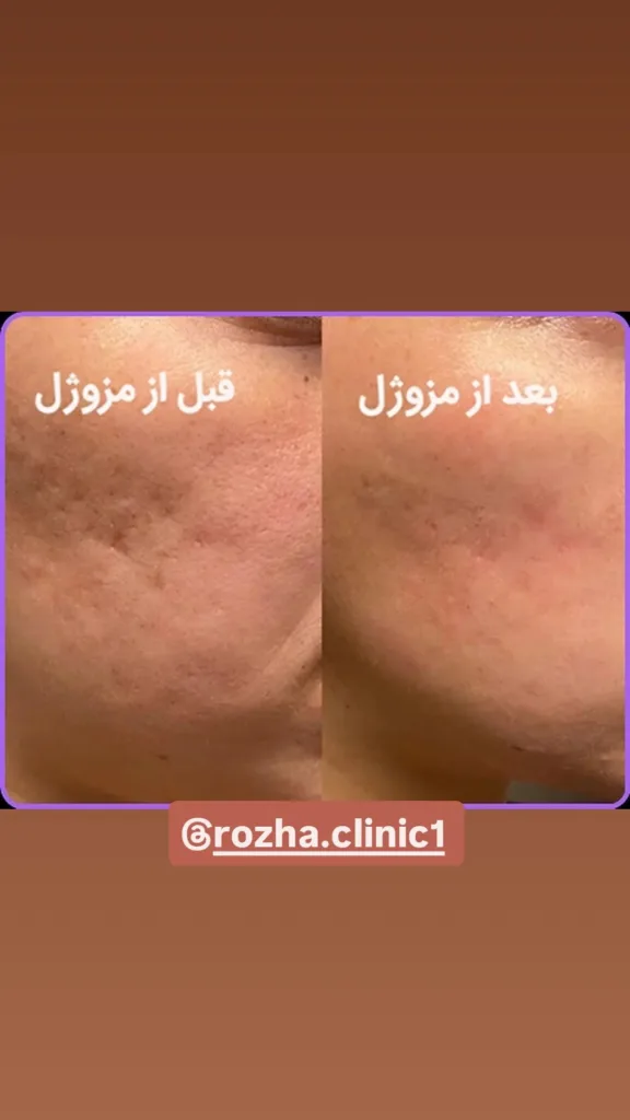 نمونه مزوژل کلینیک زیبایی روژا قزوین